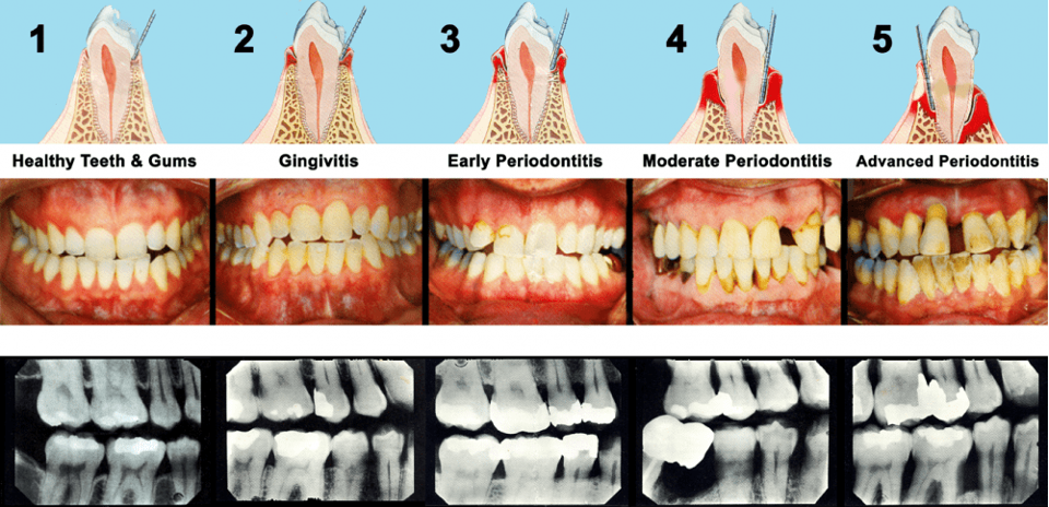 Understanding Gum Disease: Don’t Wait Until It Hurts