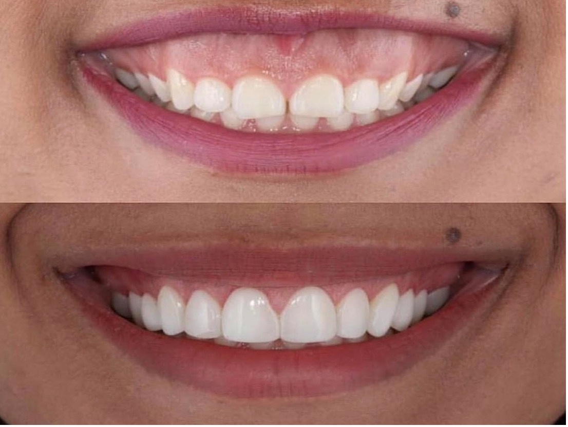 Achieving a Brighter Smile with Lasers In Modern Dentistry