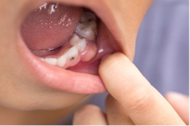 The Mouth-Body Connection: The Impact of Diet on Dental Health