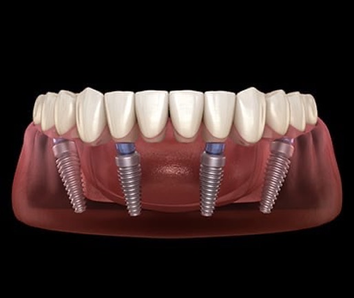 Options for Permanent Teeth Replacement