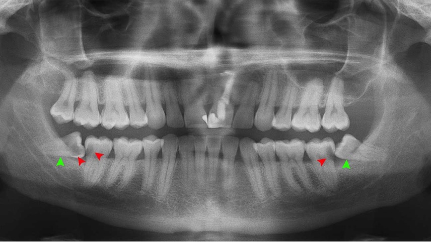 Should I Have My Wisdom Teeth Removed?