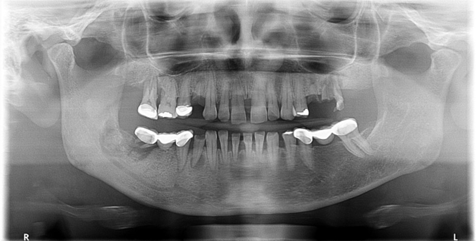 Understanding Osteoporosis, Osteonecrosis and The Dental Implications