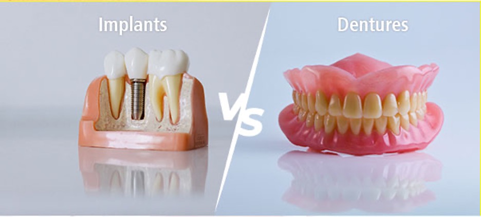 Dental Implants vs. Dentures: Choosing the Best Option for Your Smile